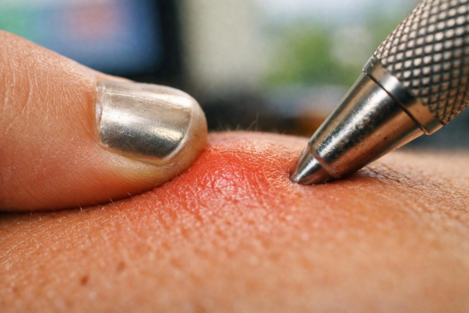 A metal pen tip presses into reddened skin beside a shiny painted fingernail